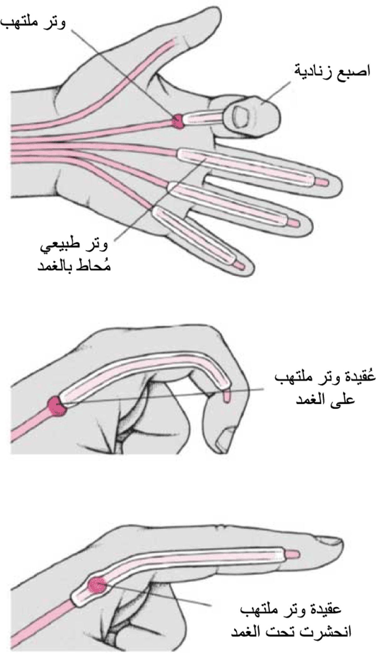 الإصبعُ ذات الوضعيَّة الزِّناديَّة