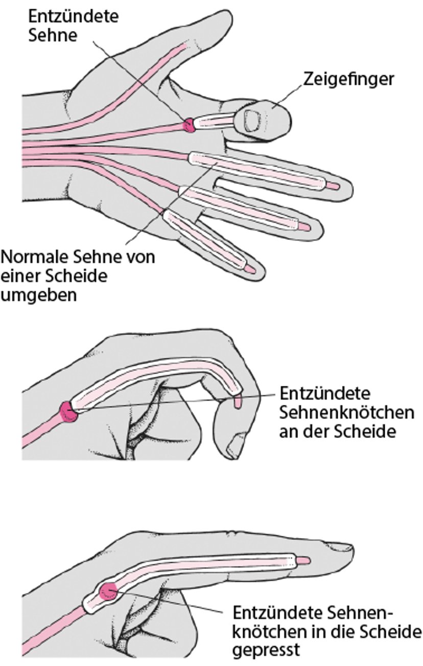 Stellung eines schnellenden Fingers