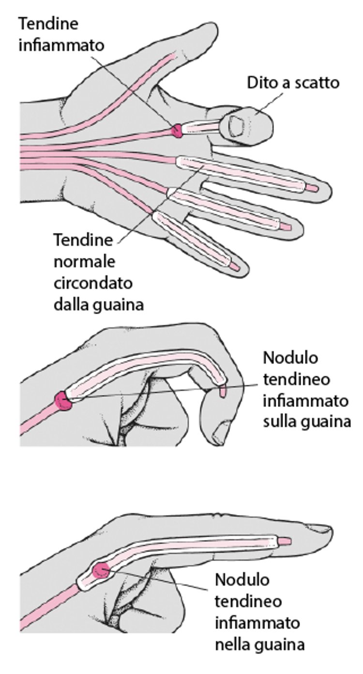 Posizione del dito a scatto