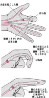 ばね指の状態