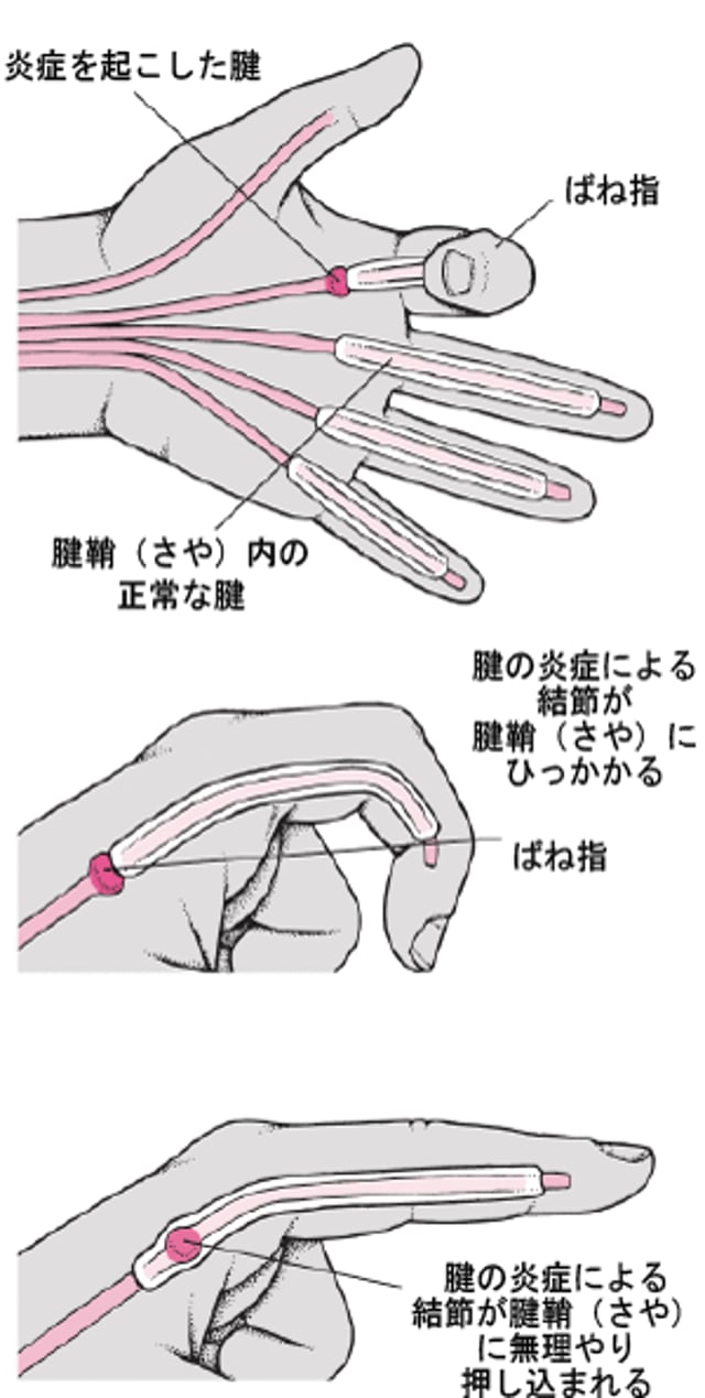 ばね指の状態