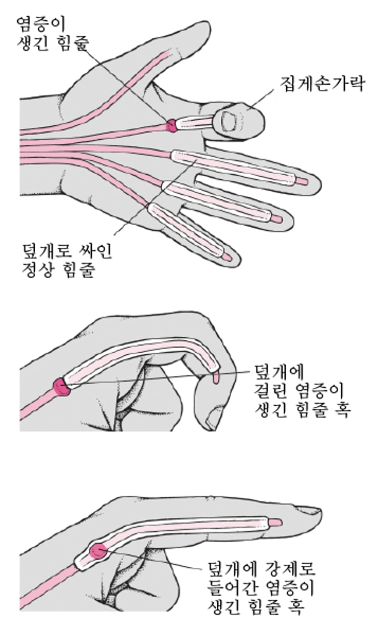 방아쇠 손가락 자세