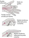 Posição de Dedo em gatilho