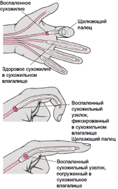 Положение щелкающего пальца