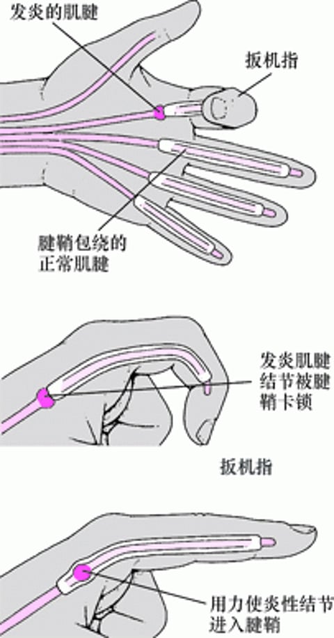 扳机指 - 扳机指 - 《默沙东诊疗手册大众版》