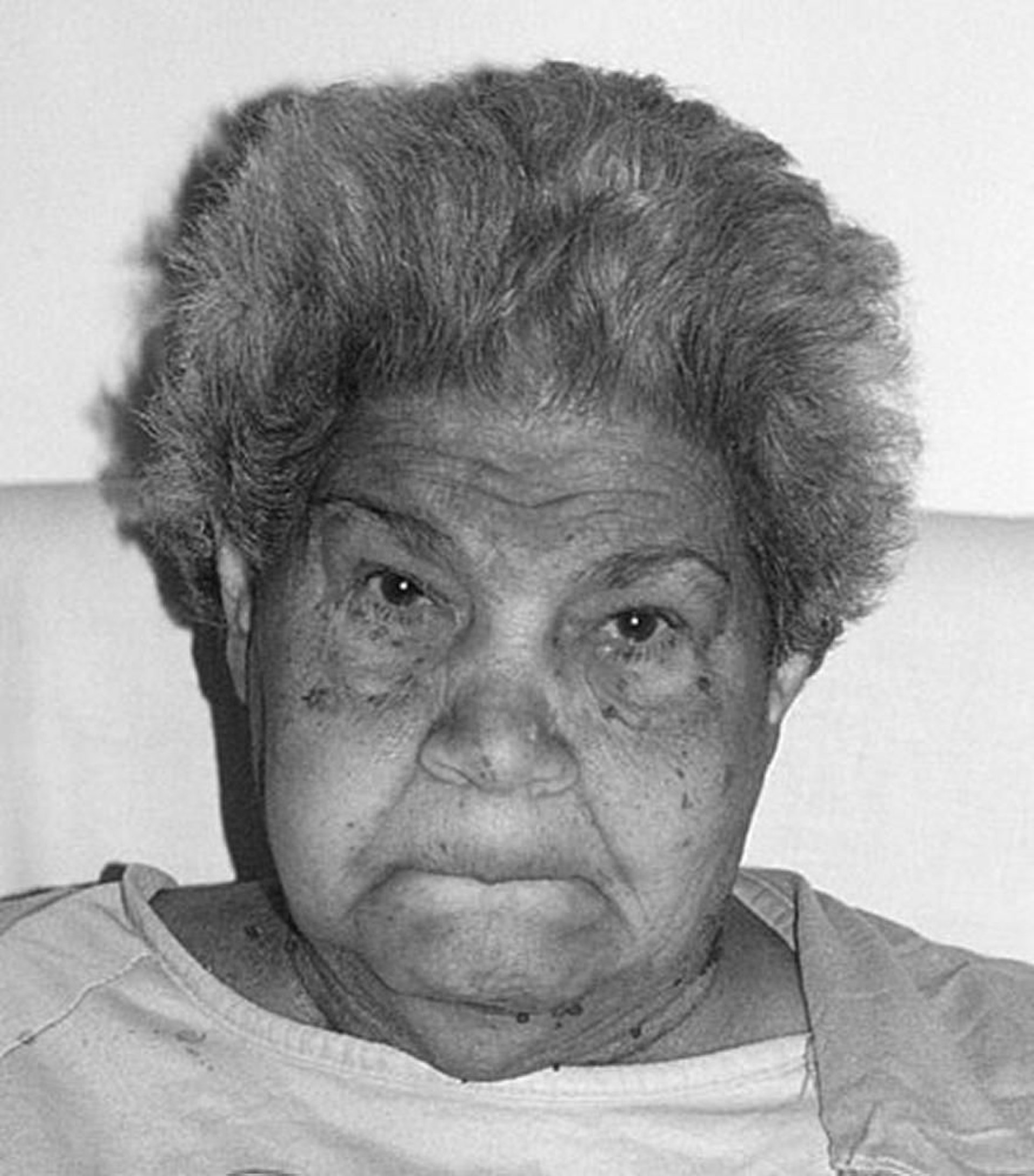 甲状腺機能低下症でみられる顔の変化