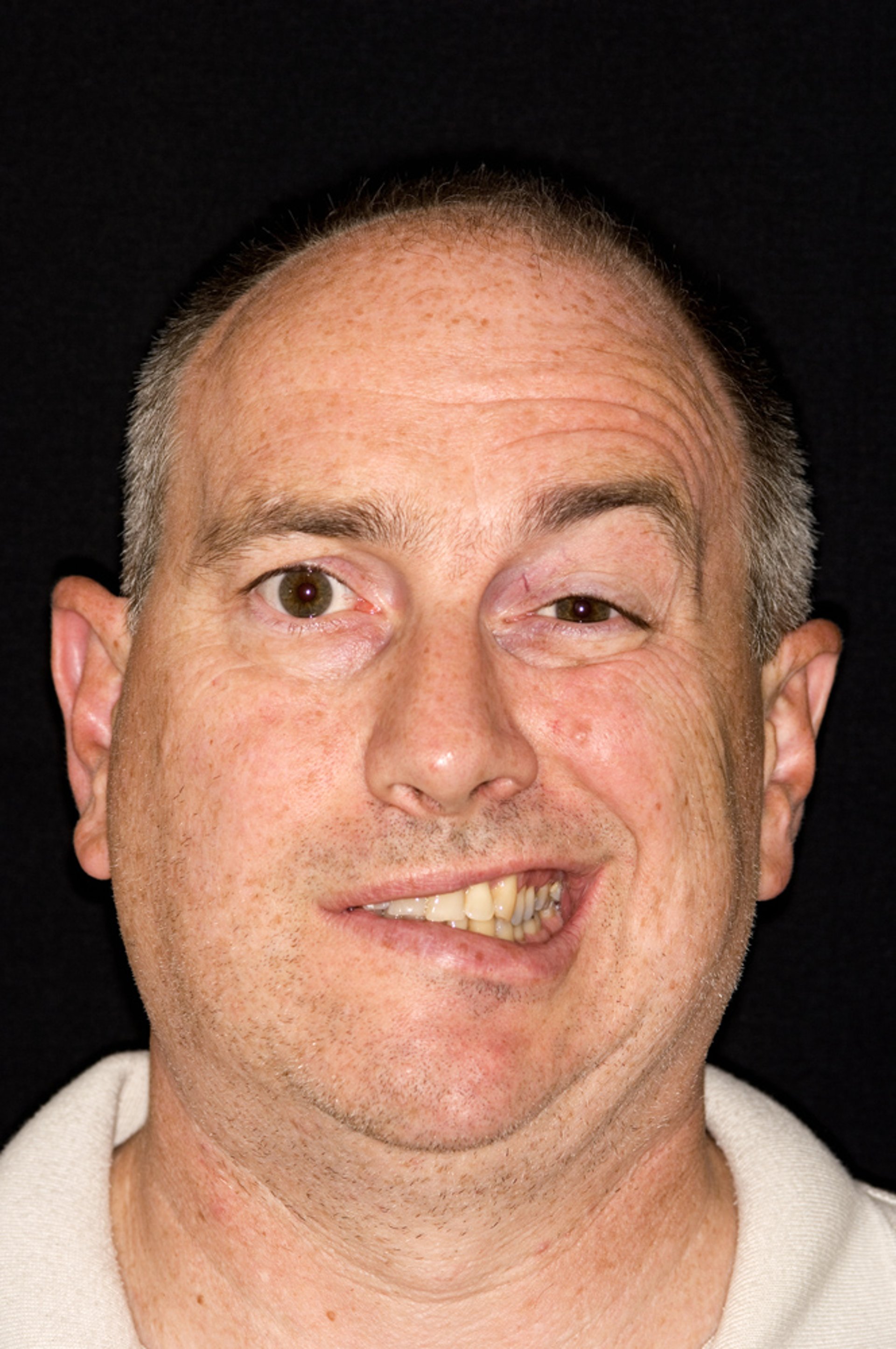 Paralysie faciale de Bell