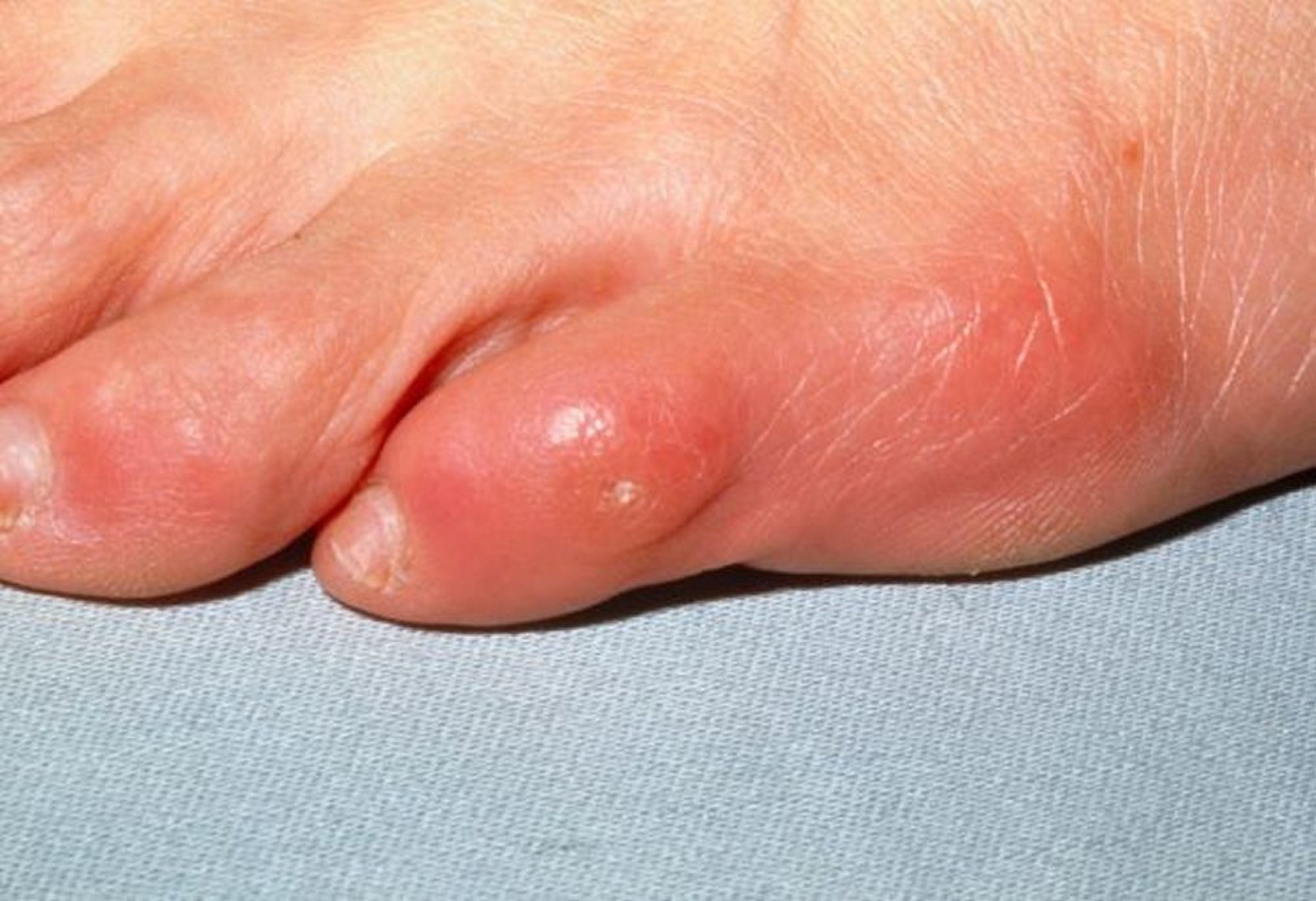 Callo (mignolo)