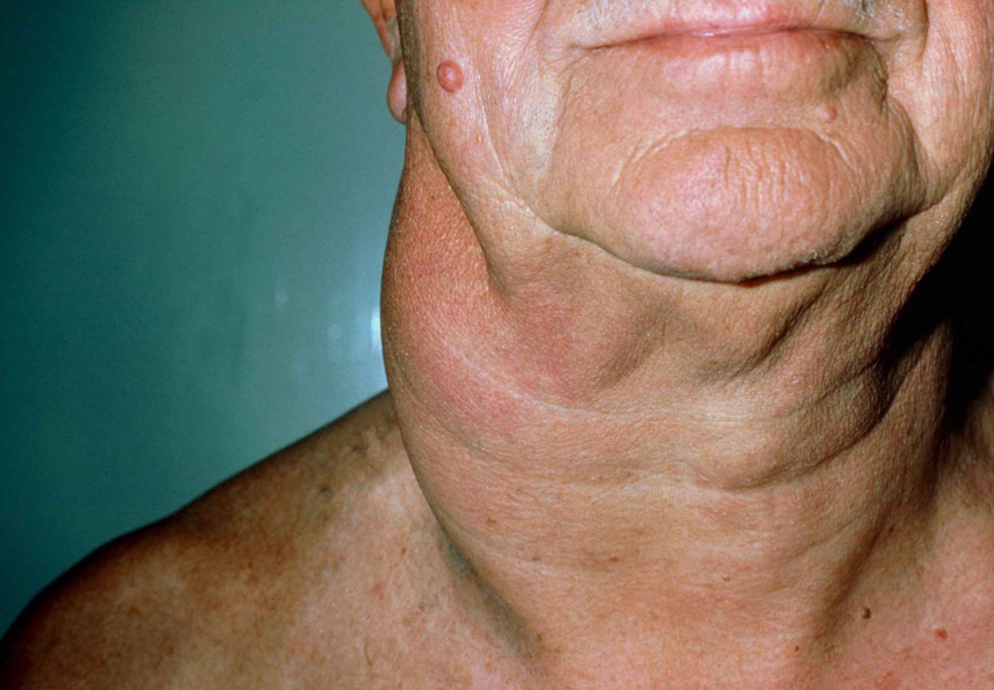 Swollen Lymph Nodes