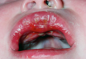 Ulcere della bocca nell’infezione da virus herpes simplex