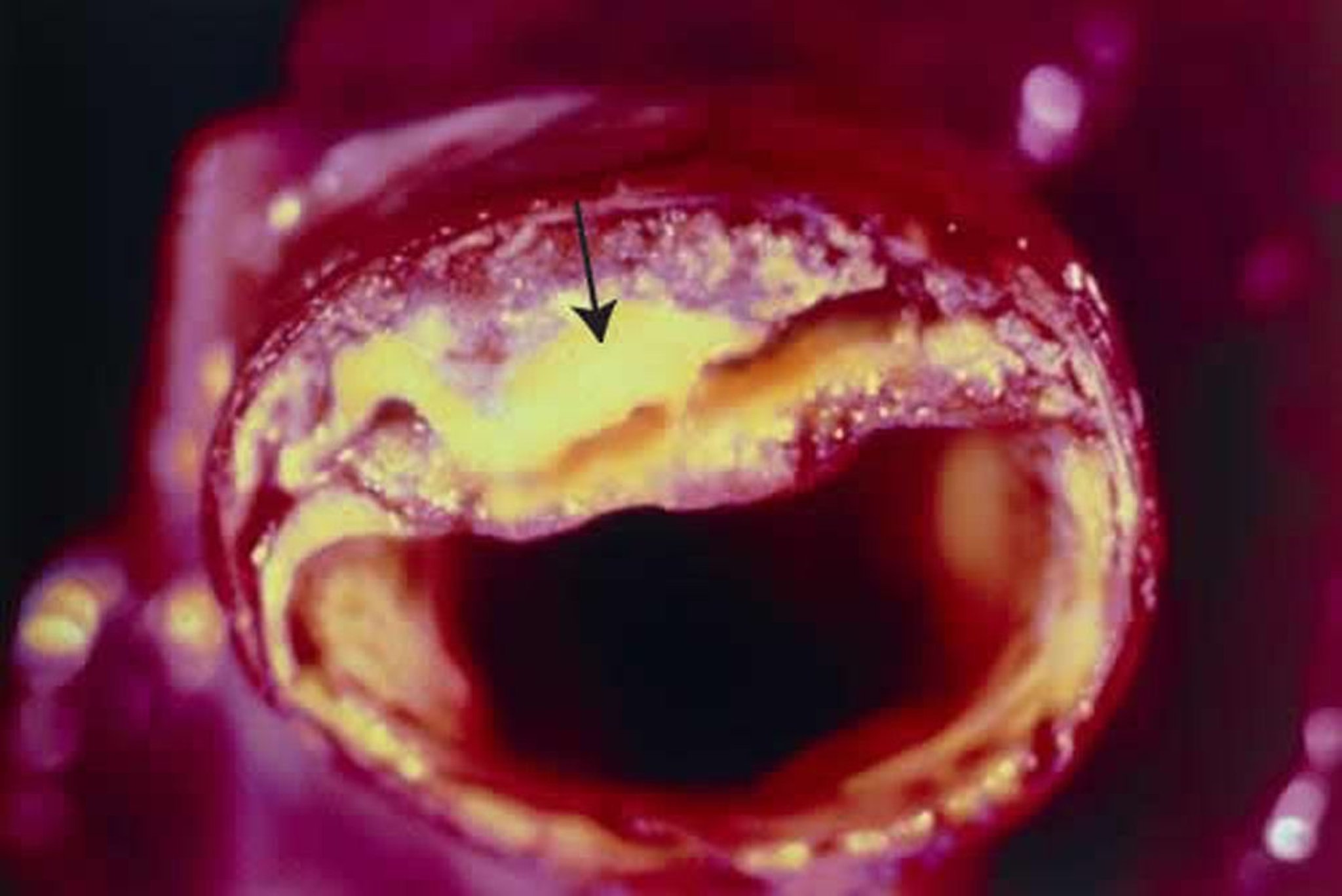 Placca aterosclerotica