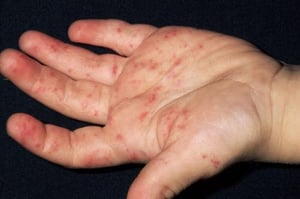 Telangiectasias on the Hand