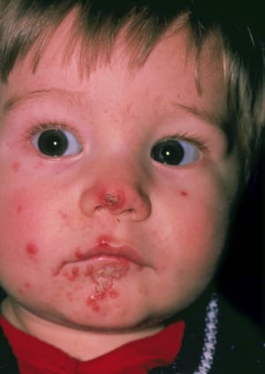 Impetigine in un bambino