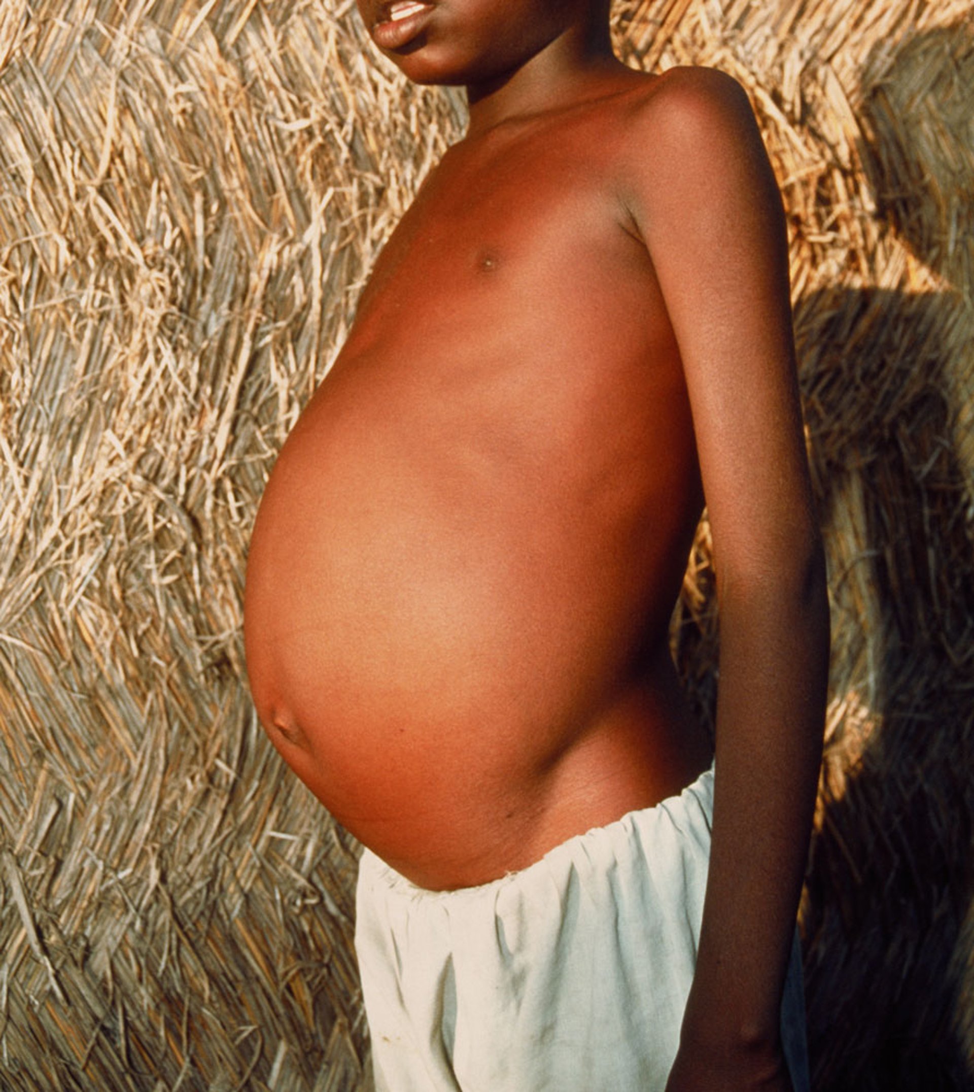 Leishmaniasis visceral