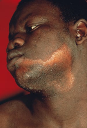 Lebbra tubercoloide