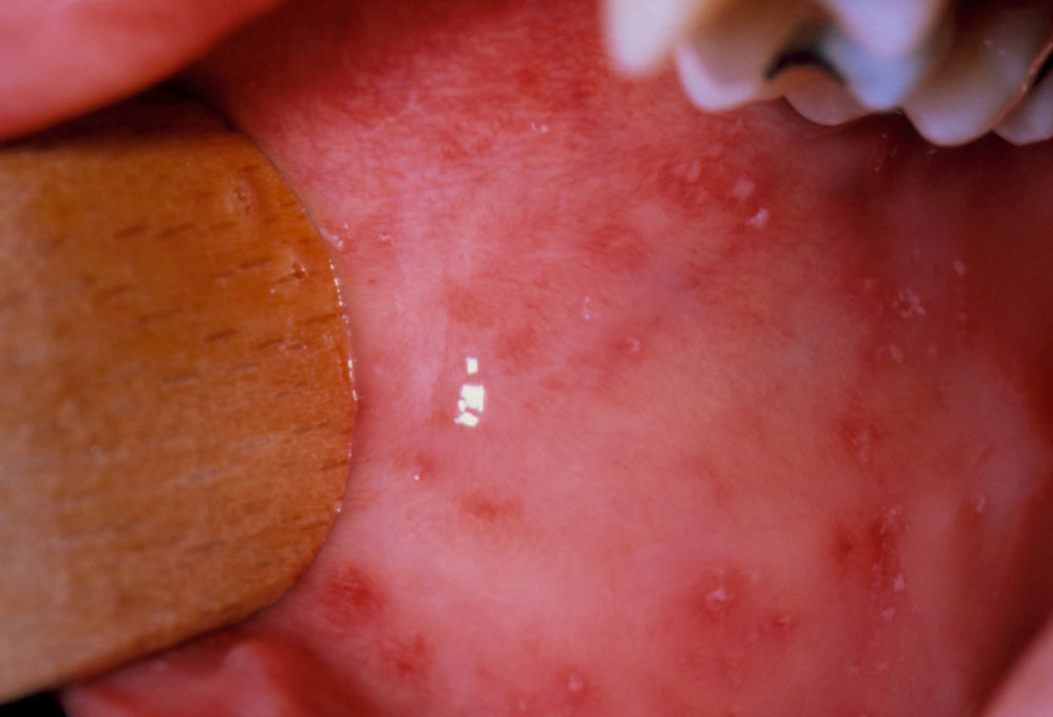 Koplik Spots in Measles (2)