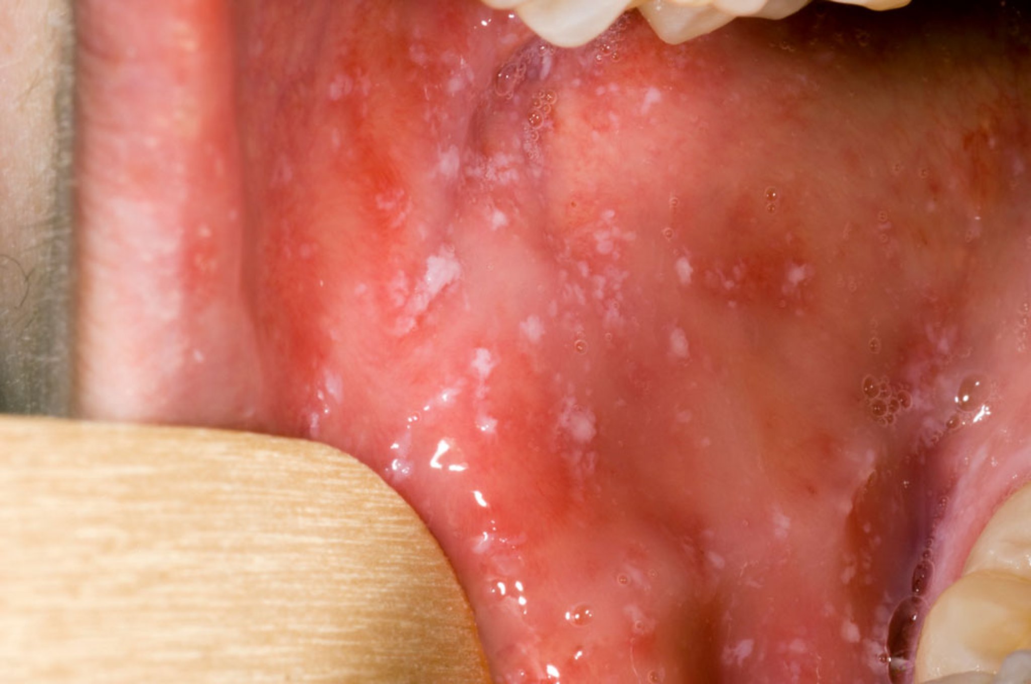 Koplik Spots in Measles (3)