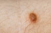 Dermatofibroma