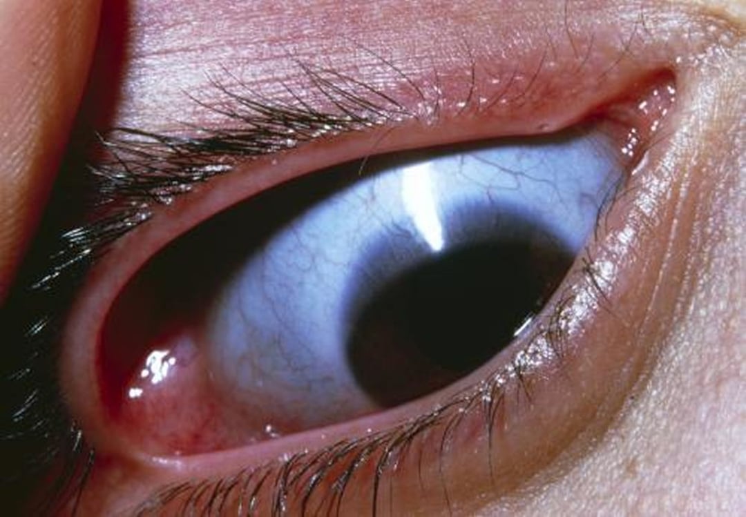 Osteogenesi imperfetta (sclera oculare azzurra)