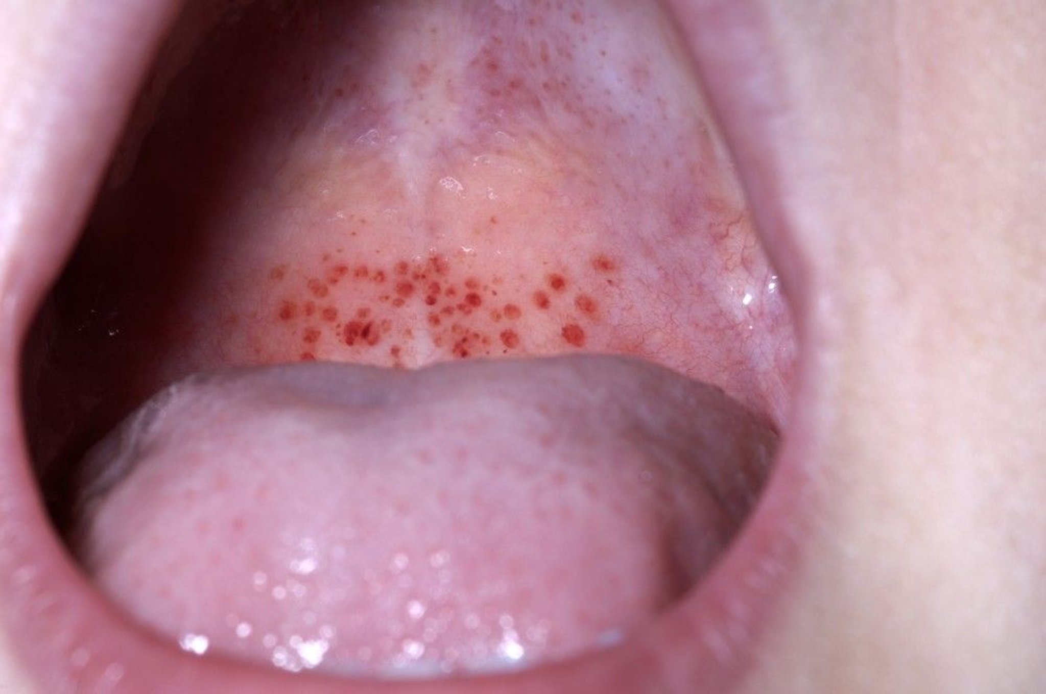 Petechiae (Mdomo)