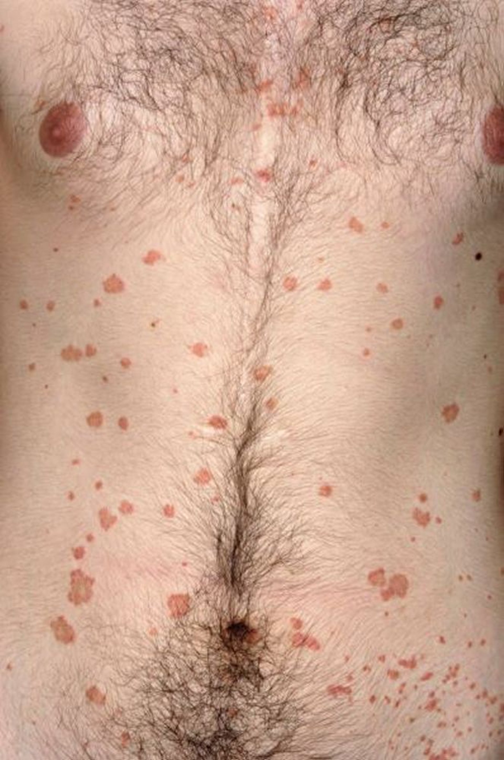 Guttate Psoriasis