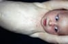 Upele Unaosababishwa na Roseola Infantum