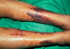Bruising in Scurvy