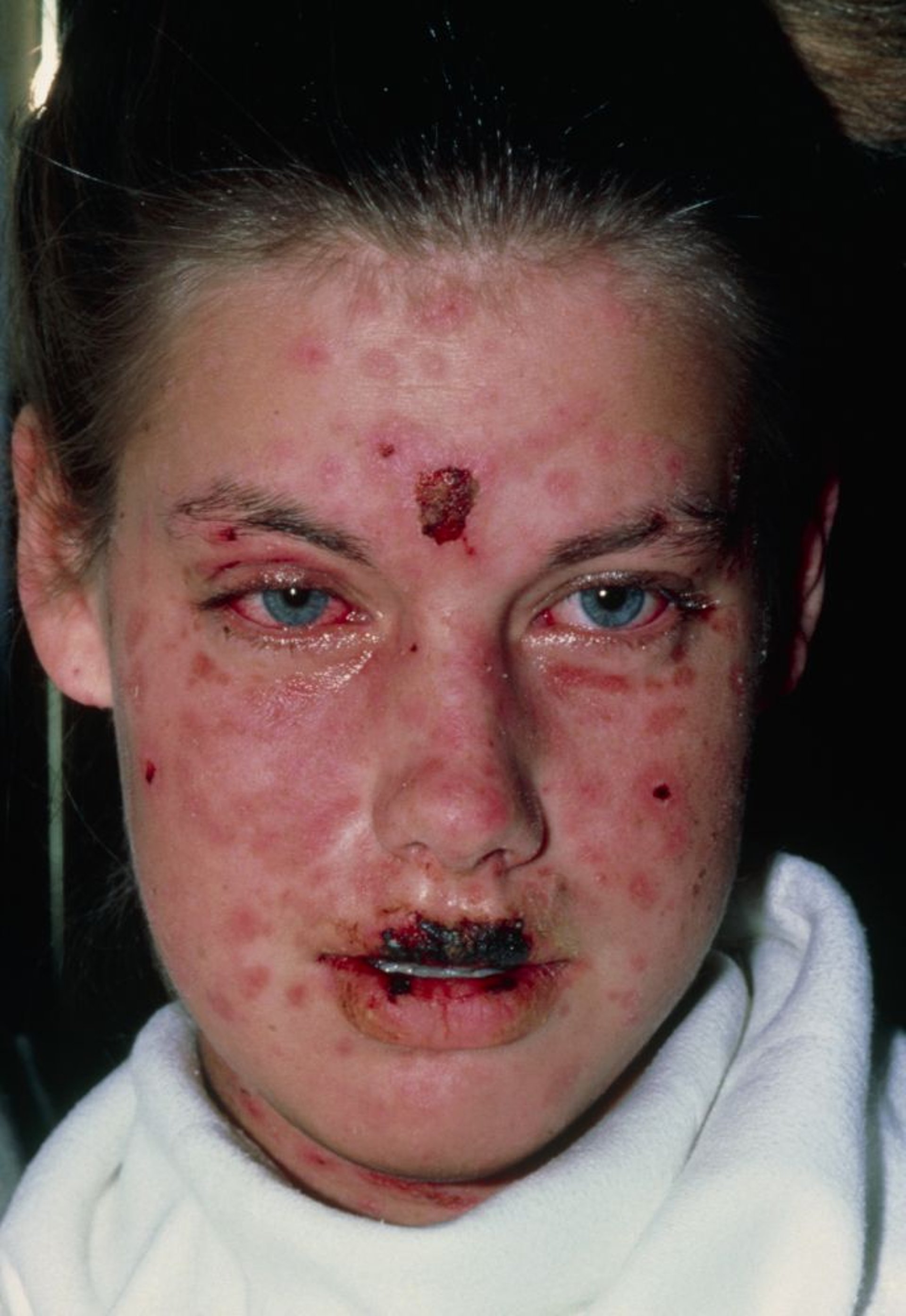 Sindrome di Stevens-Johnson (SJS)