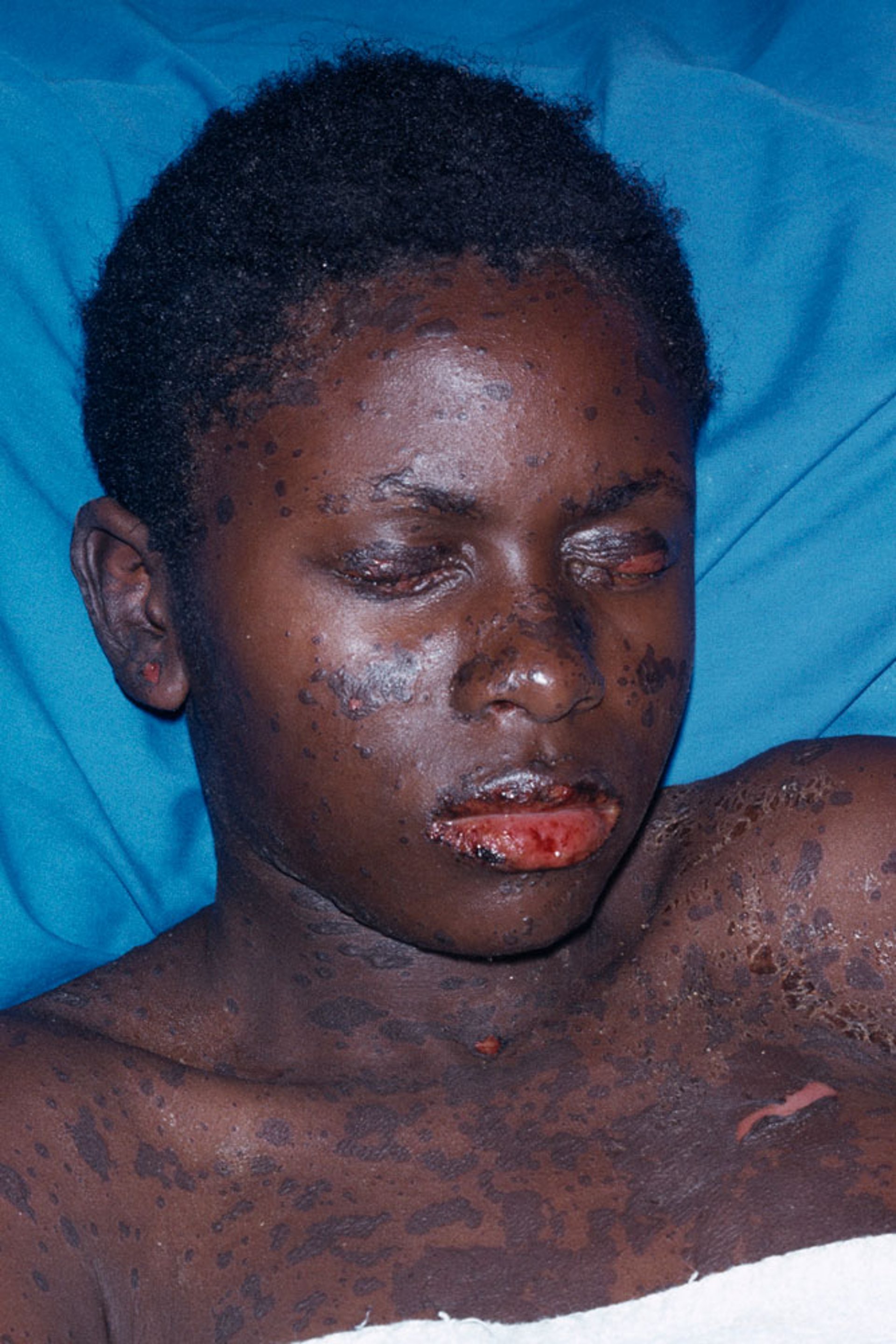 Ugonjwa wa Stevens-Johnson (SJS)