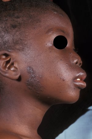 Angiofibroma (Adenoma Sebaceum) pada Tuberous Sclerosis Complex