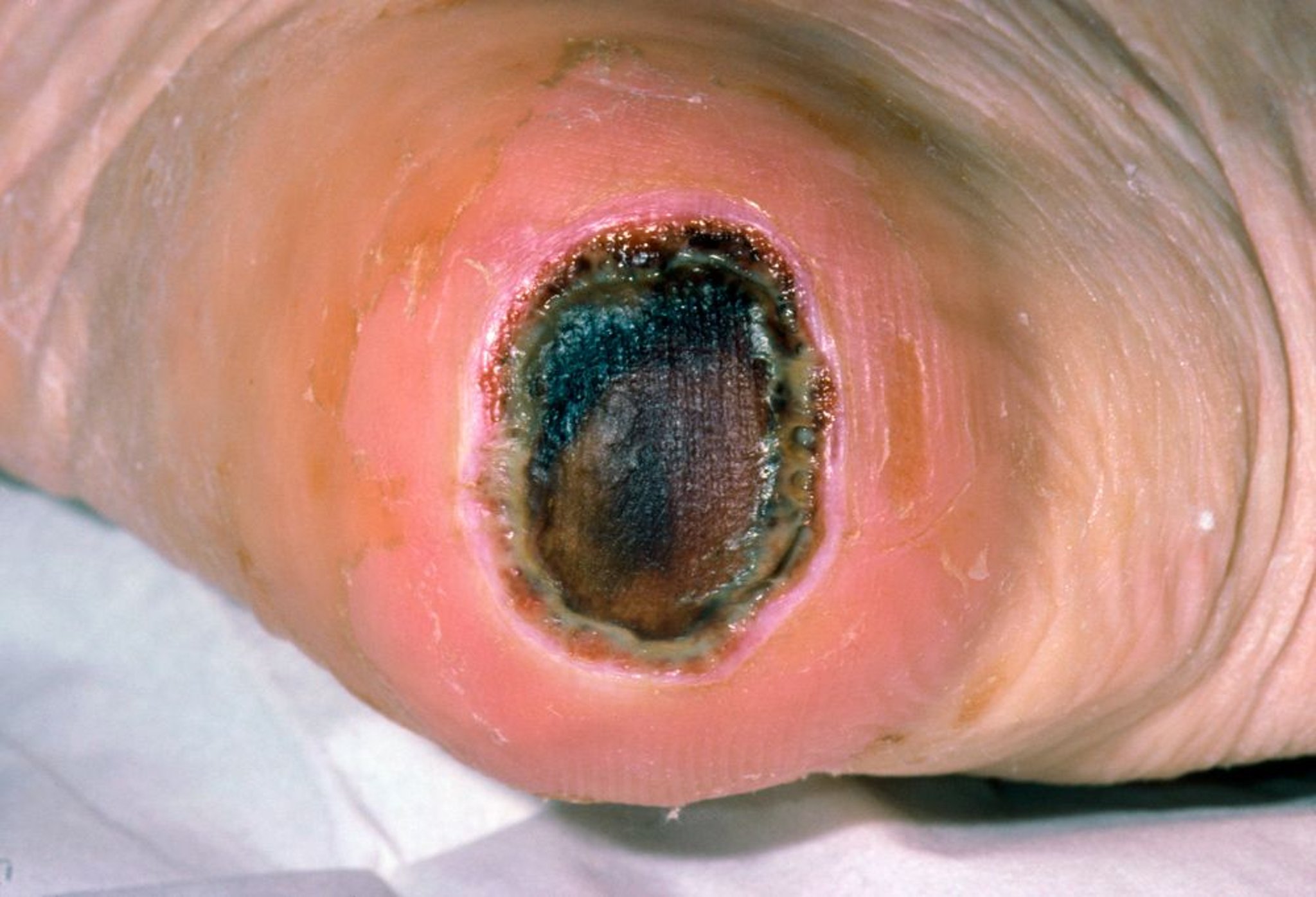 Druckgeschwür 3. Grades (Ferse)