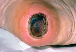 Úlcera de decúbito em estágio III (calcanhar)