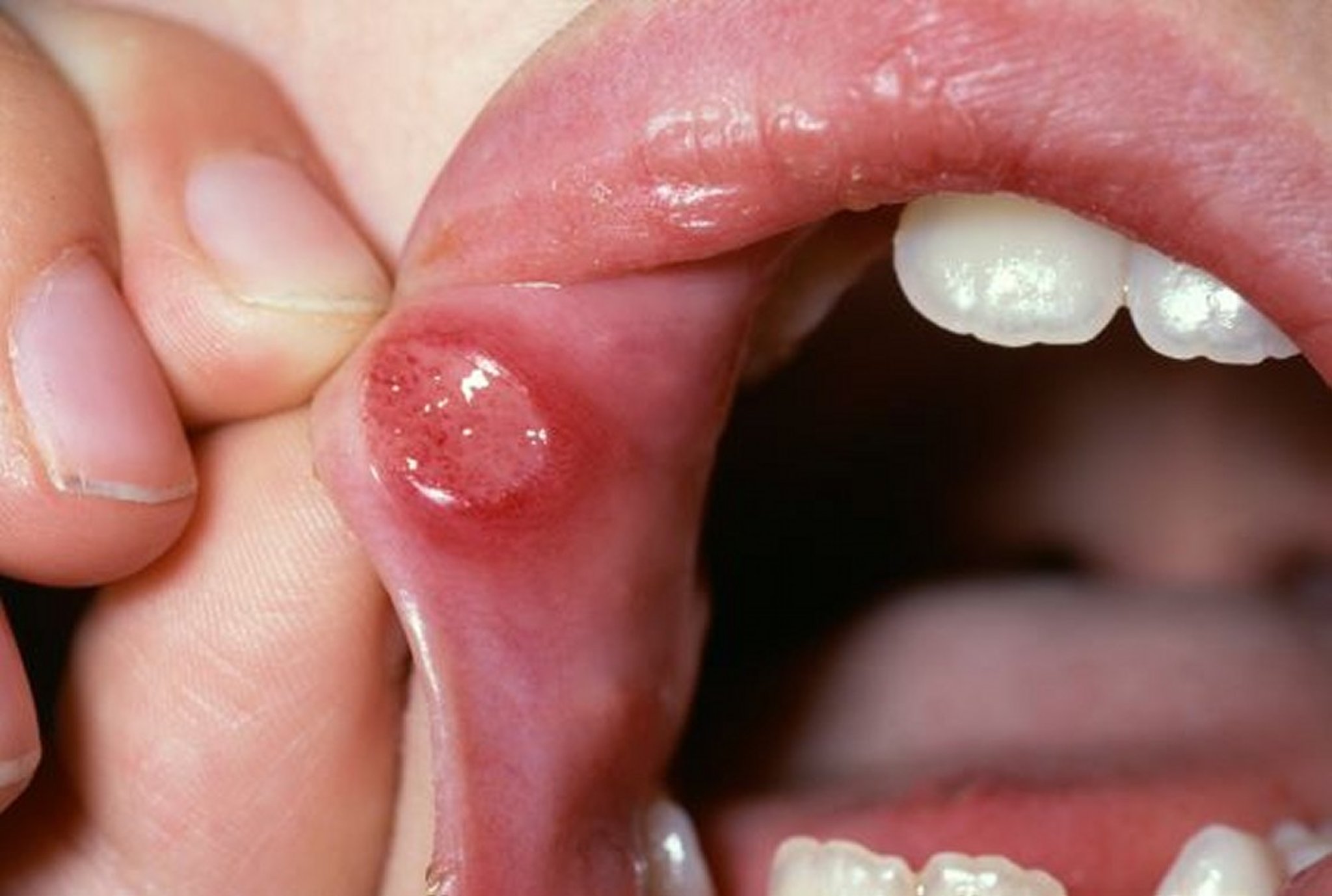 Canker Sore