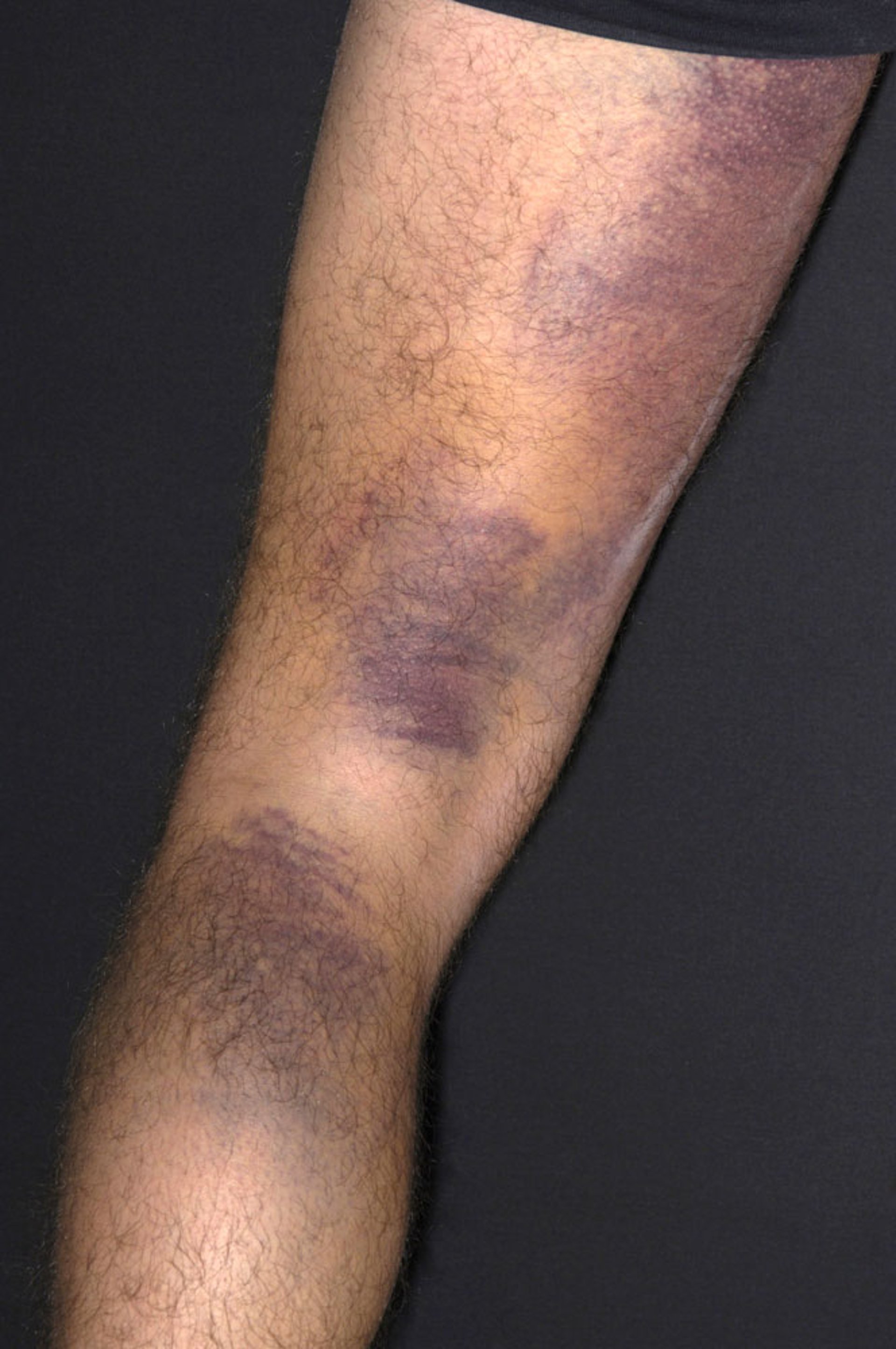Ecchymoses (Bruises)