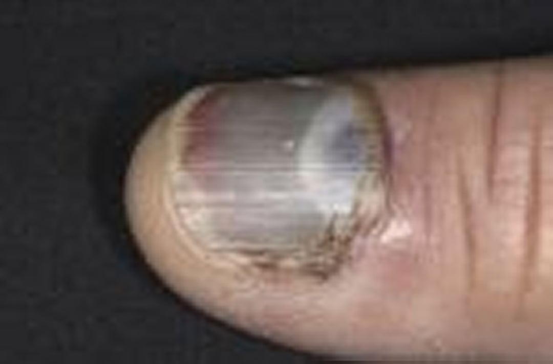 Ematoma subungueale (unghia della mano)