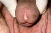 Gonorrhea