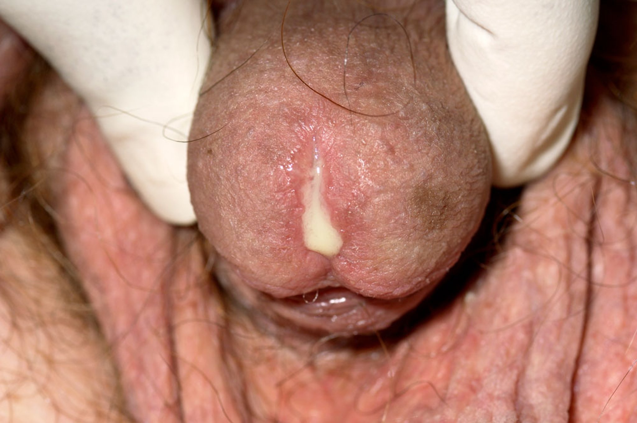 Gonorrea