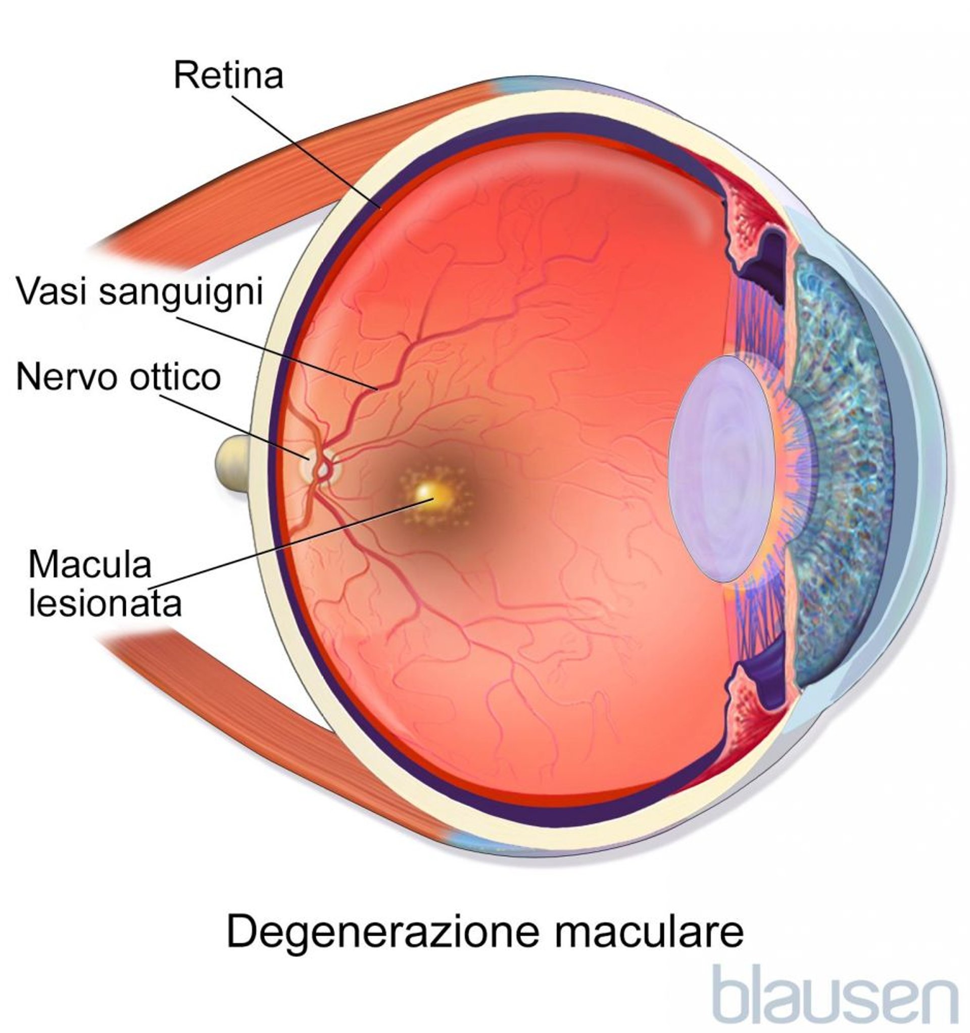 Degenerazione maculare