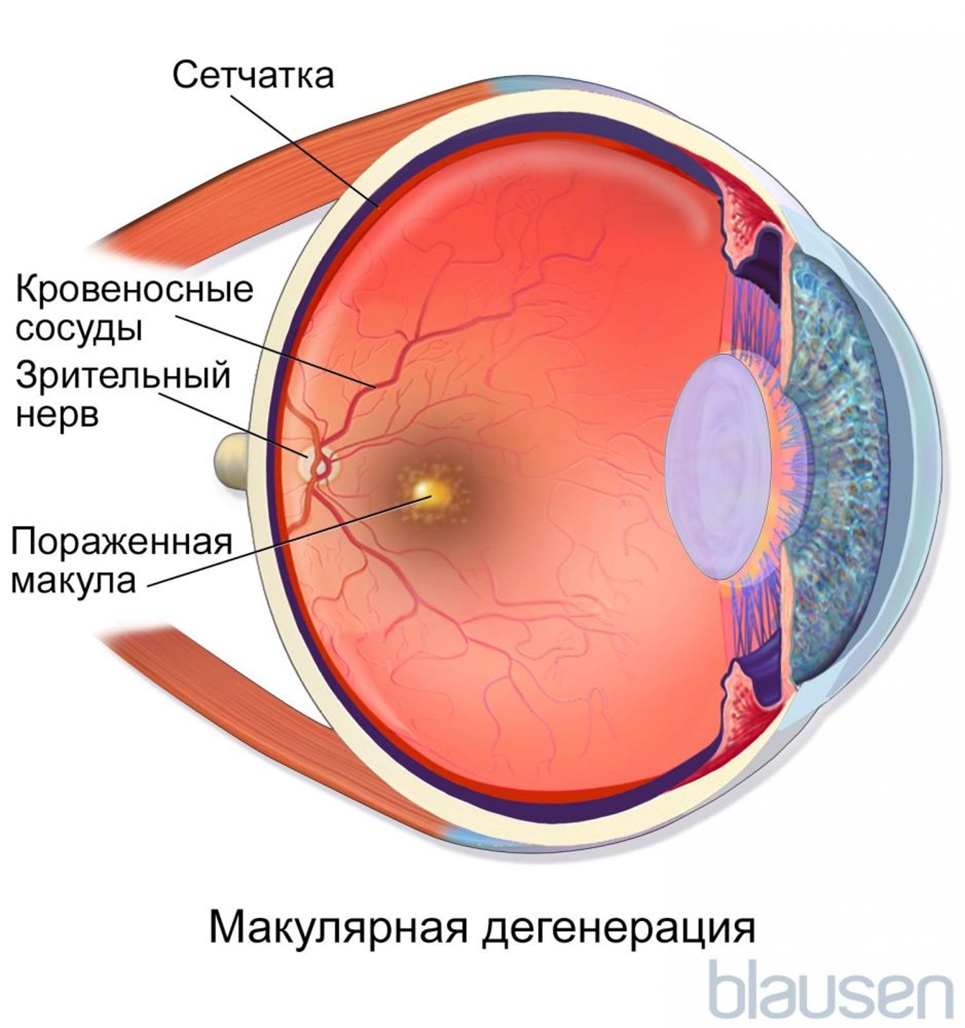 Дегенерация желтого пятна