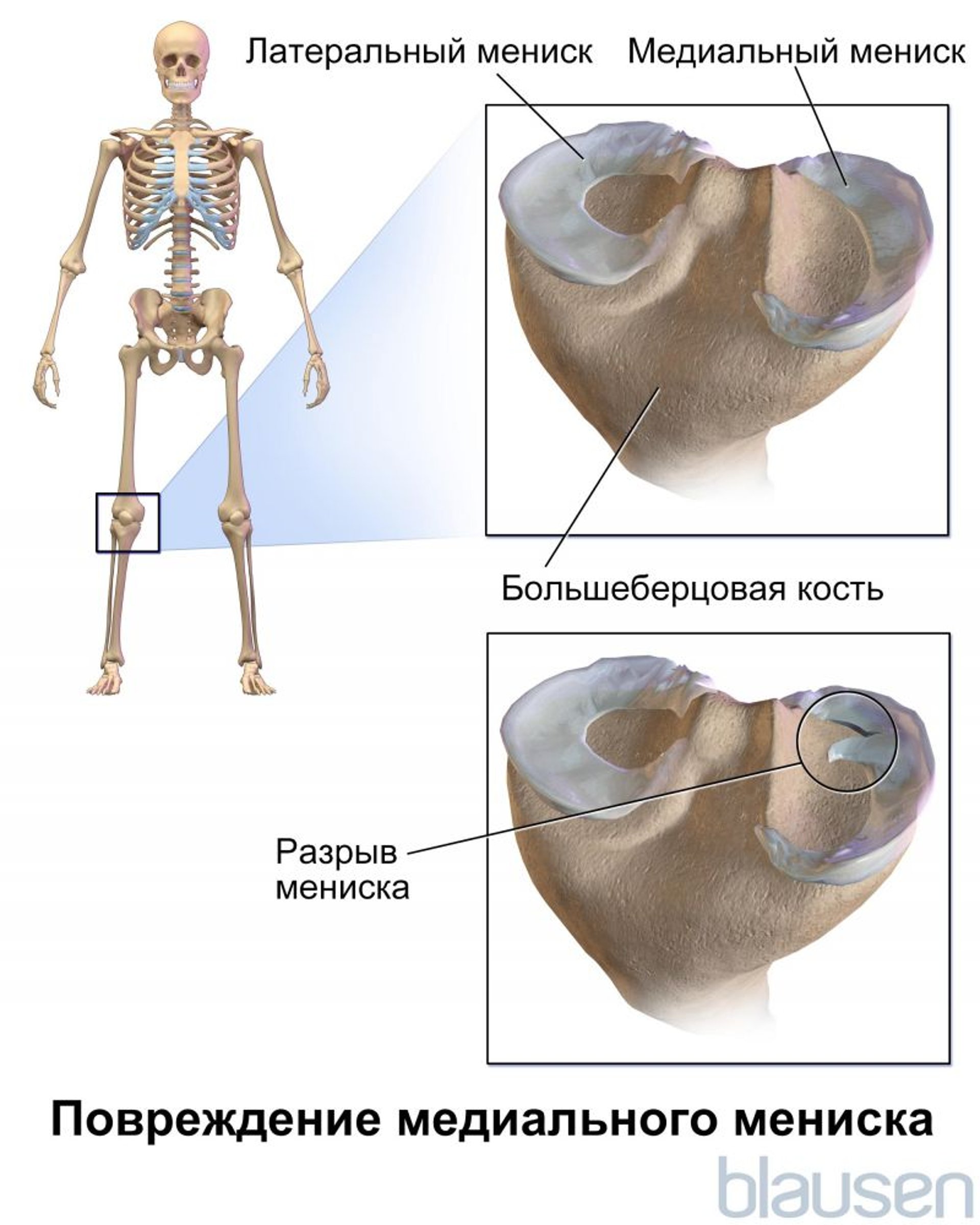 Повреждение внутреннего мениска