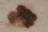 Melanoma a diffusione superficiale
