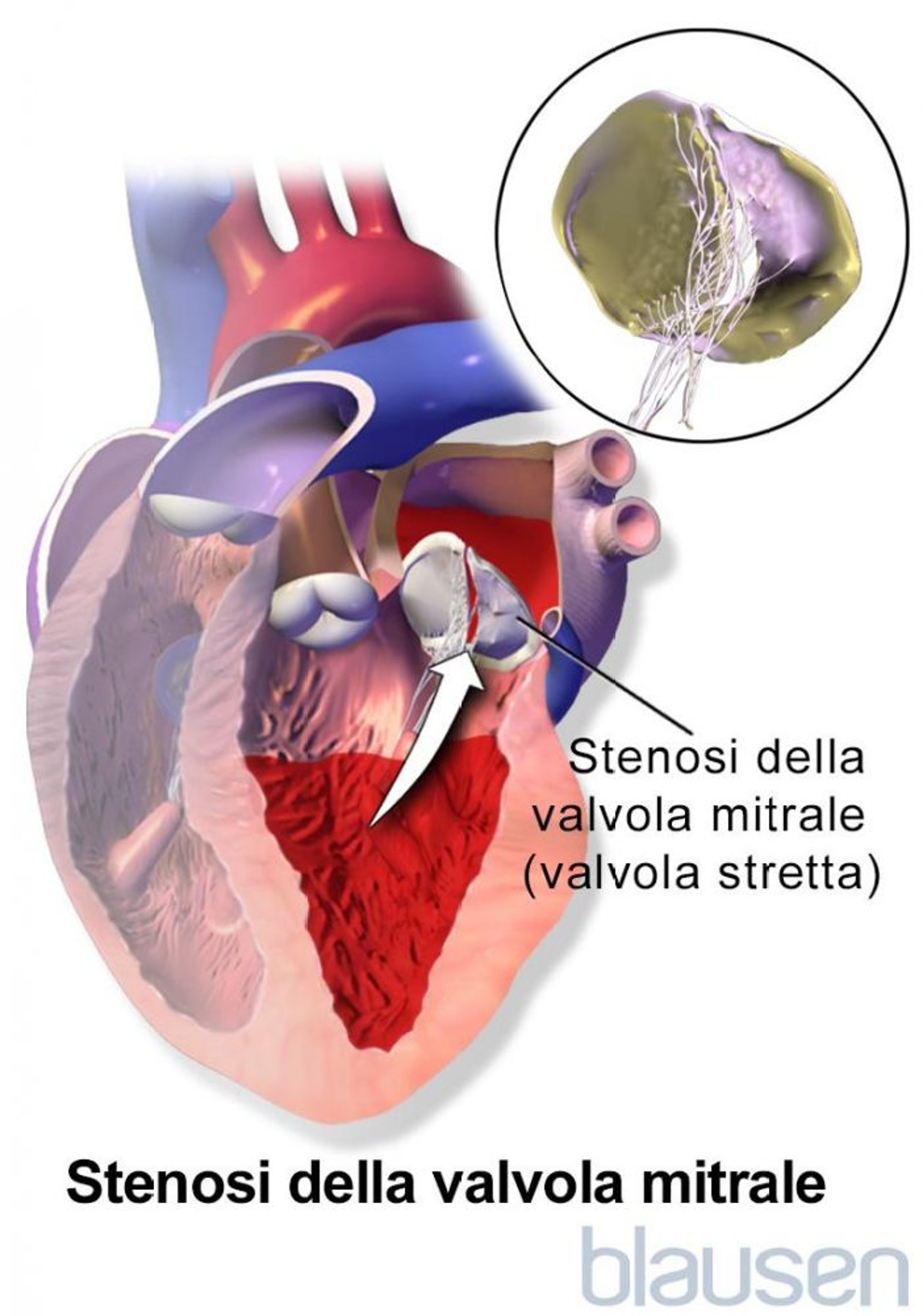Stenosi della valvola mitrale