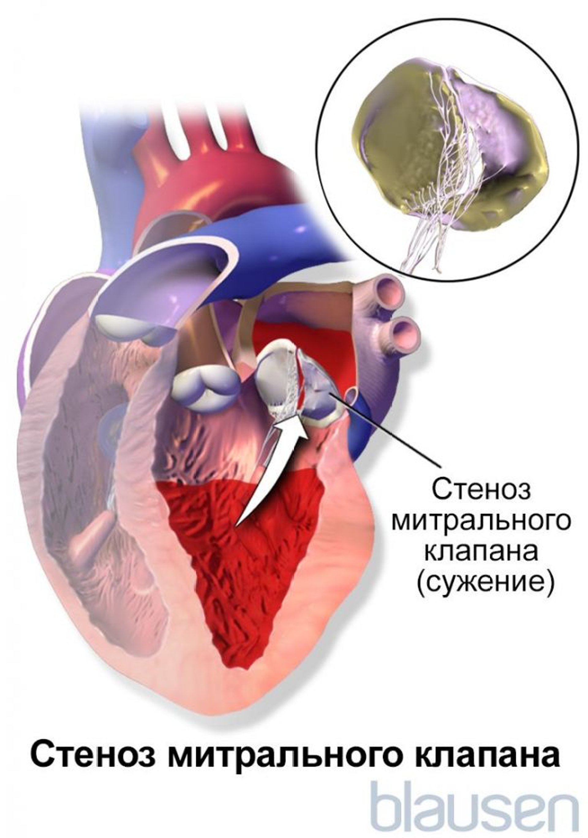 Стеноз митрального клапана