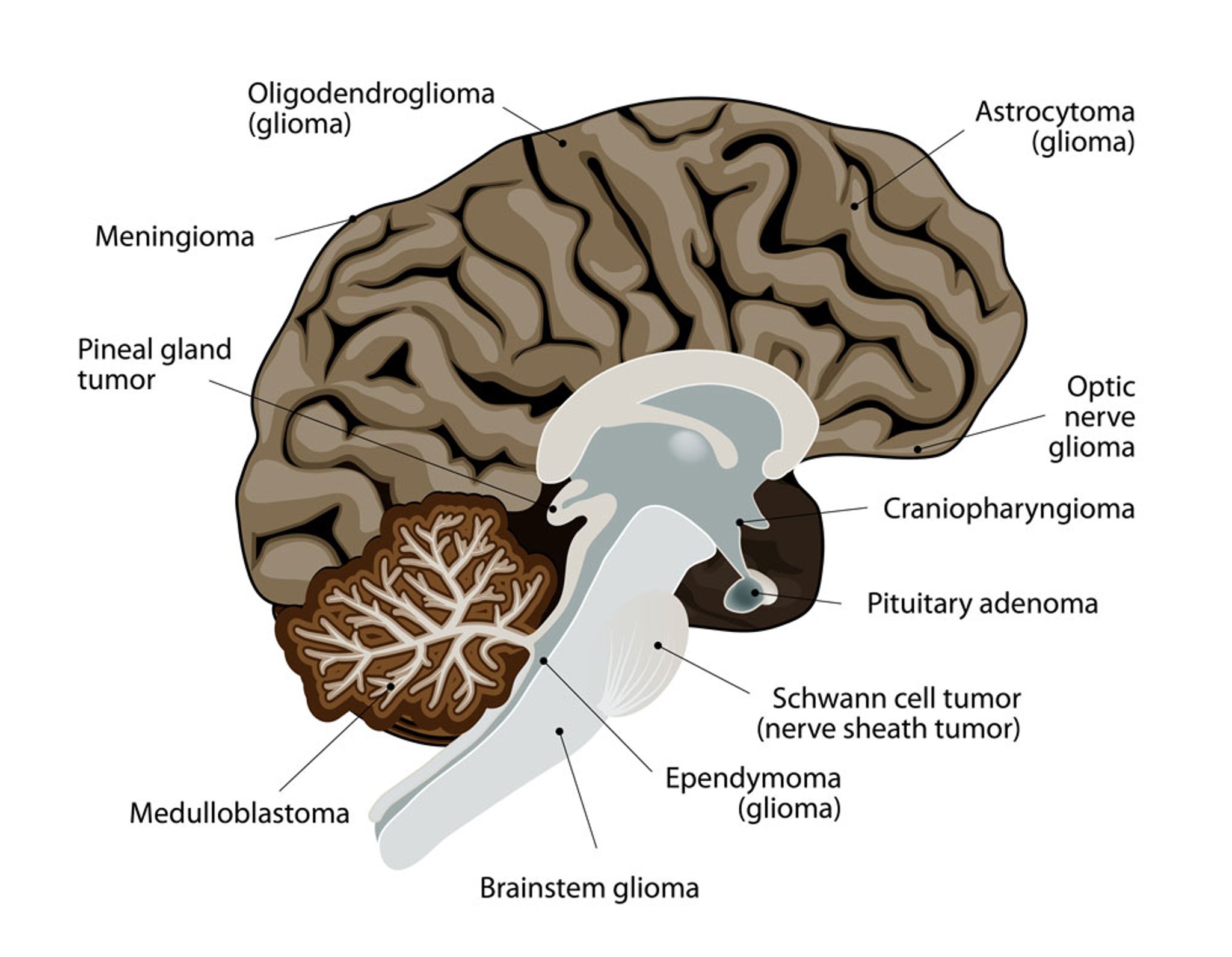Brain Tumors
