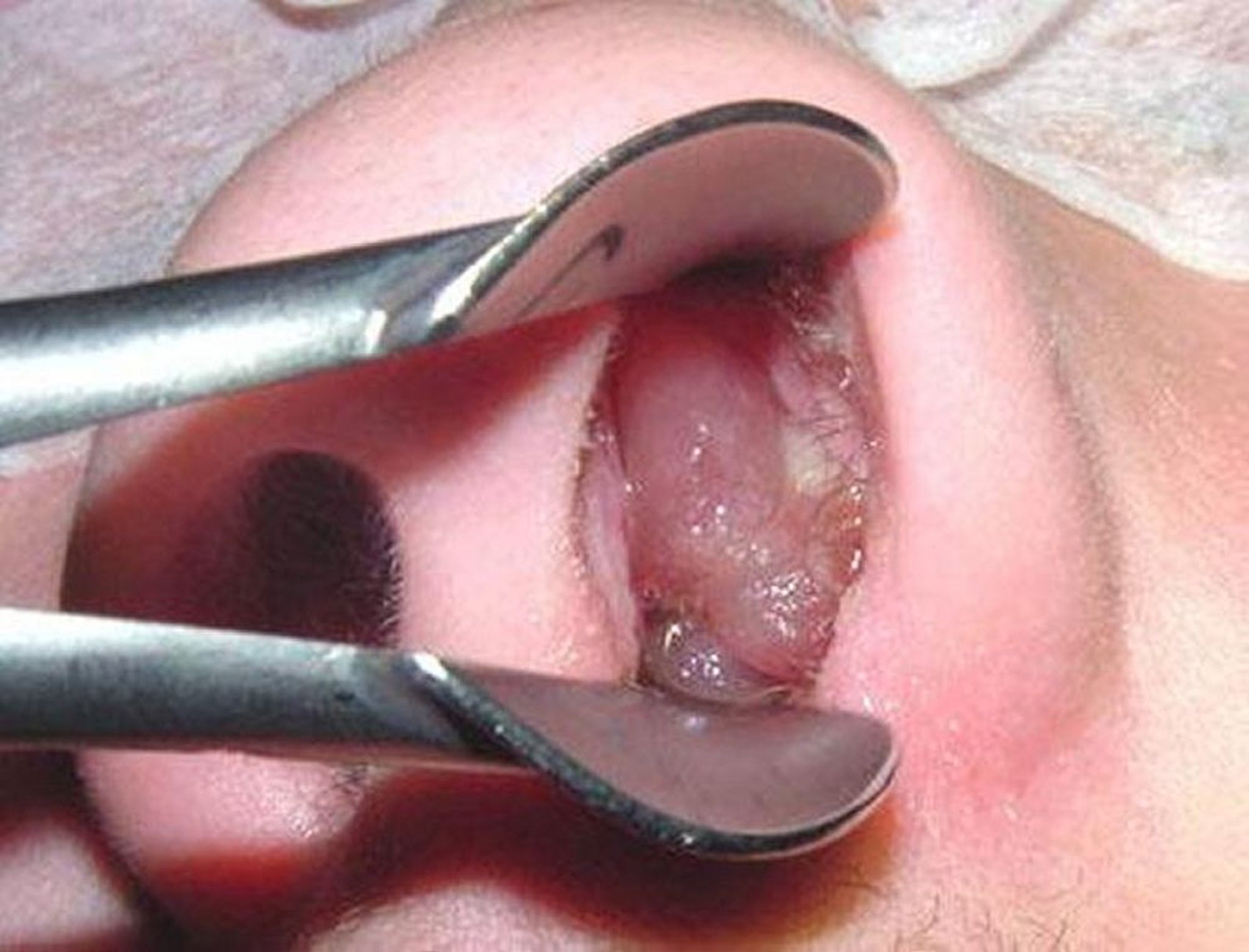Nasal Polyps