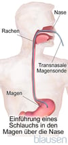 Transnasale Magensonde