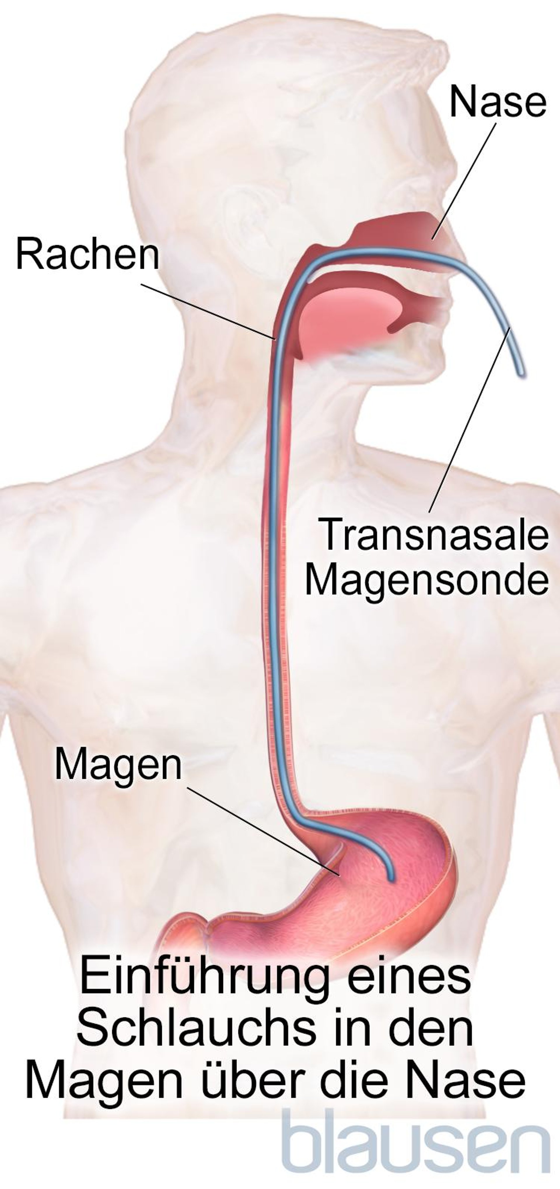 Transnasale Magensonde