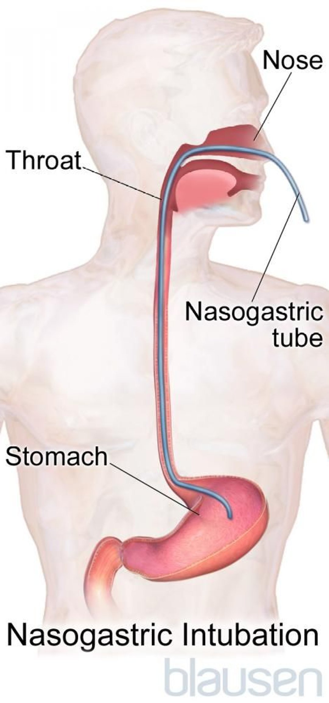 Intubación nasogástrica