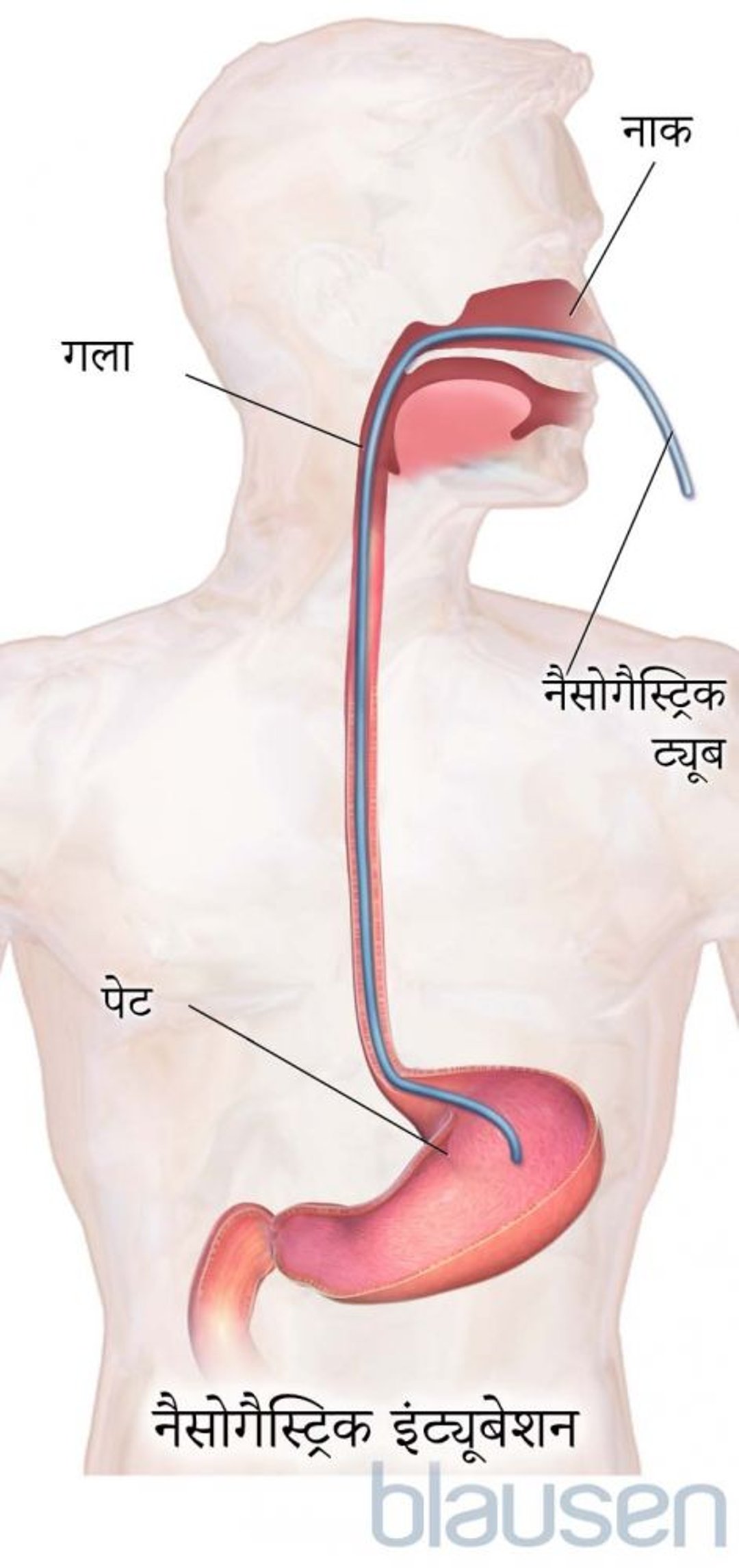 नैसोगैस्ट्रिक इंट्यूबेशन