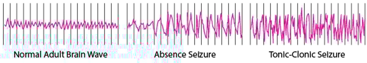 Brain Activity During a Seizure